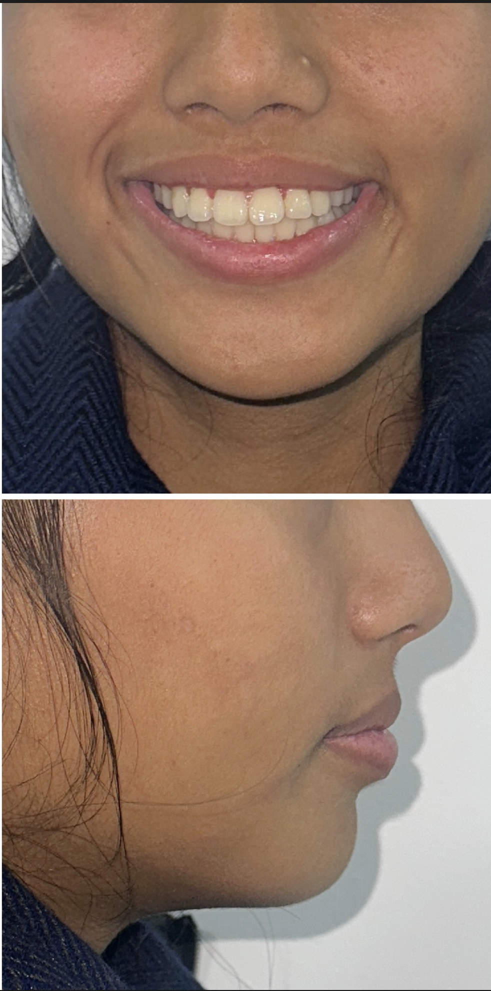 After Smile Makeover