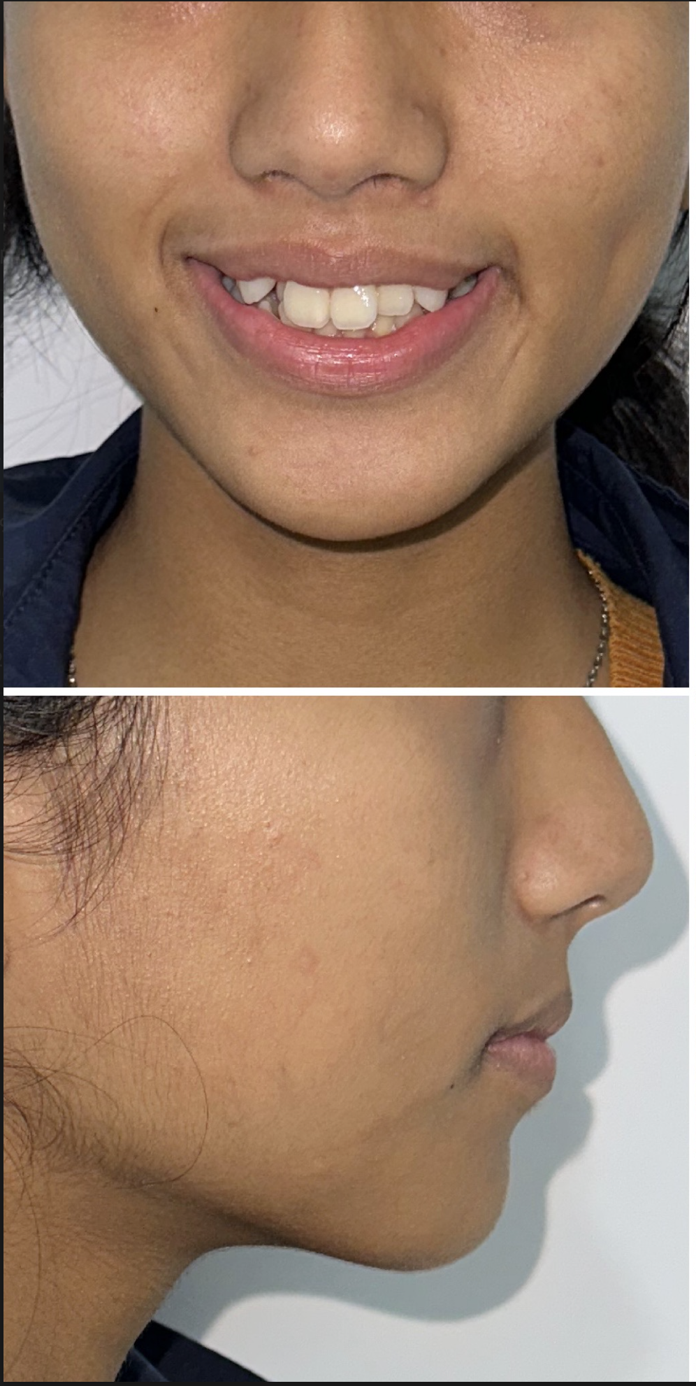 Before Smile Makeover